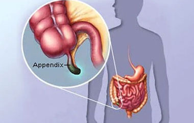 Appendix or Appendicitis