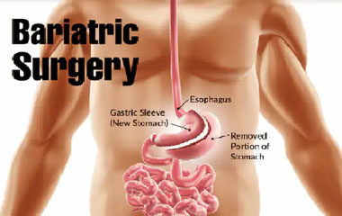Bariatric Surgery