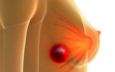Breast Lumps