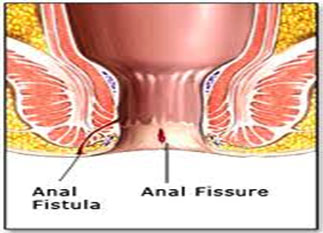 Fissure
