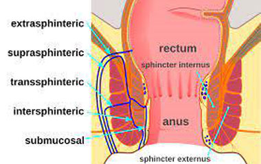 Fistula In Ano