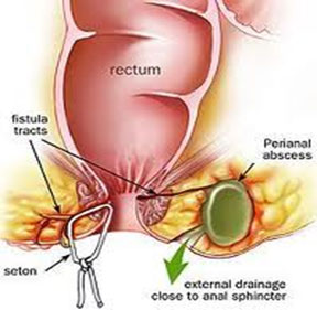 Fistula