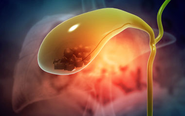 Gall Bladder Stones