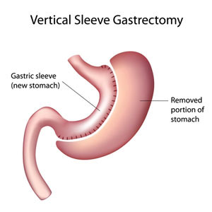 Bariatric Surgery