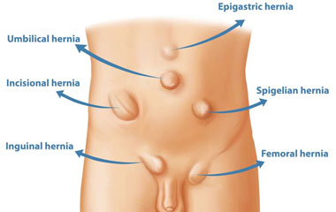 Hernia