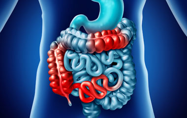 Intestinal Obstruction