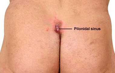 Pilonidal Sinus