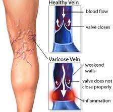 Varicose Veins